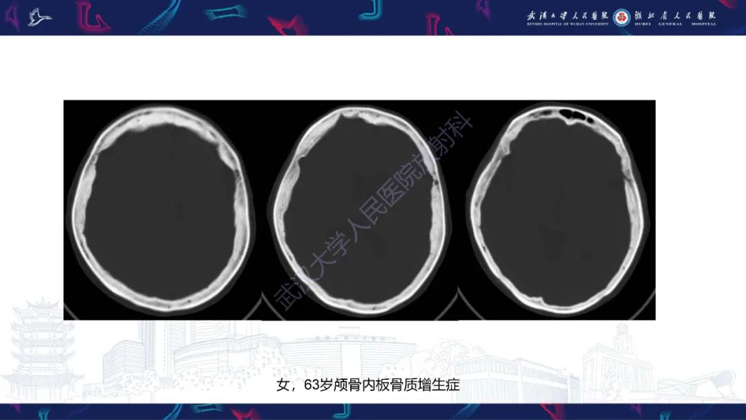 影像PPT - 【PPT】颅骨弥漫性病变影像诊断-21