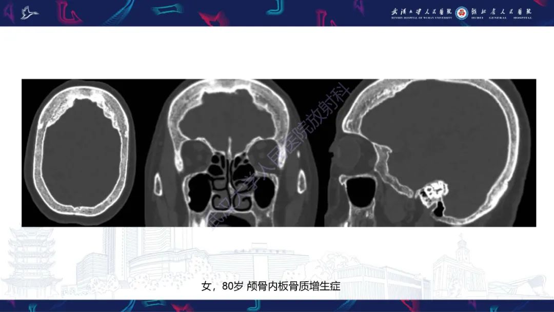 影像PPT - 【PPT】颅骨弥漫性病变影像诊断-22