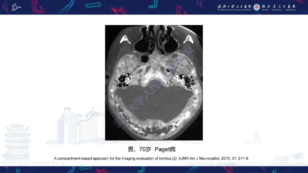影像PPT - 【PPT】颅骨弥漫性病变影像诊断-24
