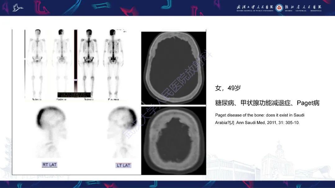 影像PPT - 【PPT】颅骨弥漫性病变影像诊断-26