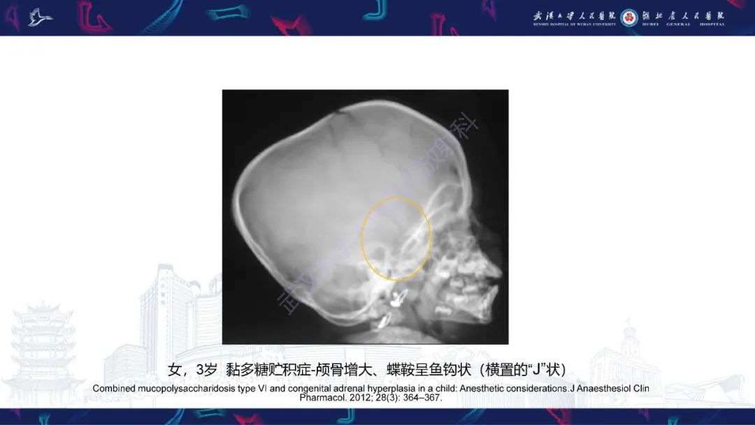 影像PPT - 【PPT】颅骨弥漫性病变影像诊断-28