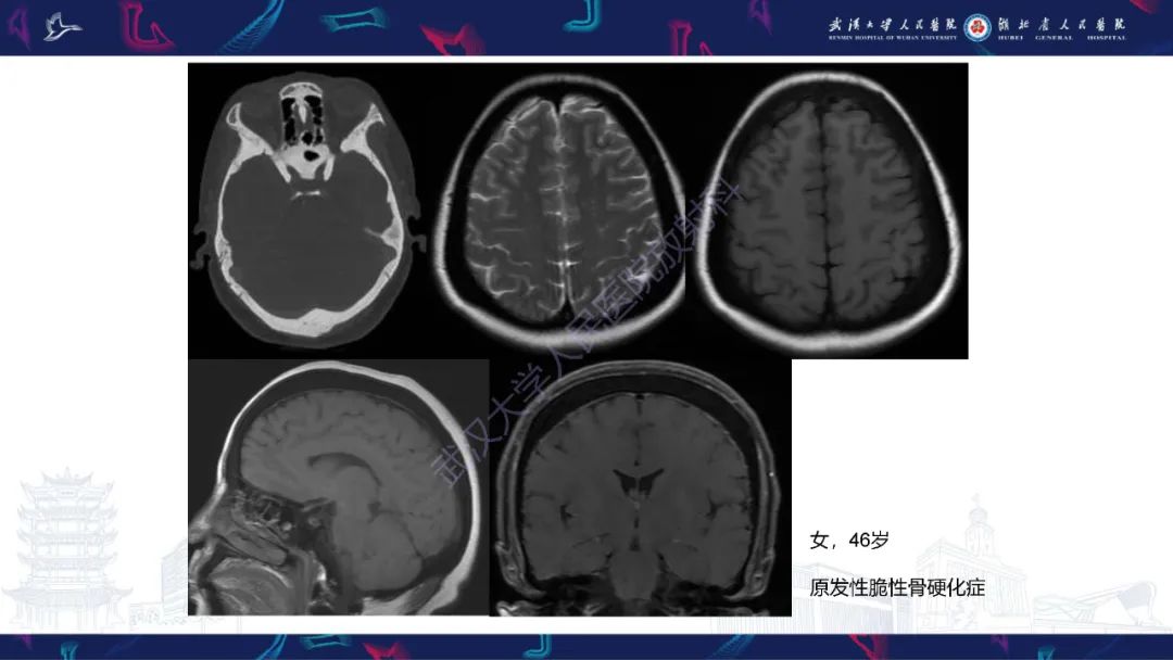 影像PPT - 【PPT】颅骨弥漫性病变影像诊断-30