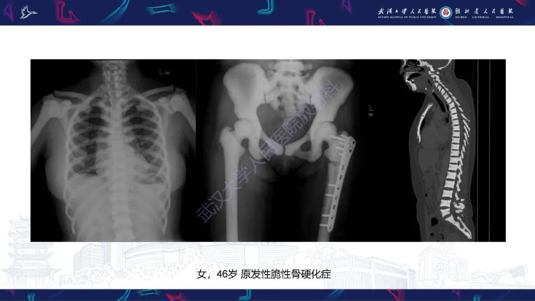 影像PPT - 【PPT】颅骨弥漫性病变影像诊断-31