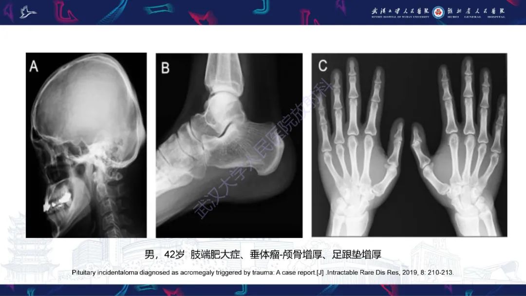 影像PPT - 【PPT】颅骨弥漫性病变影像诊断-33