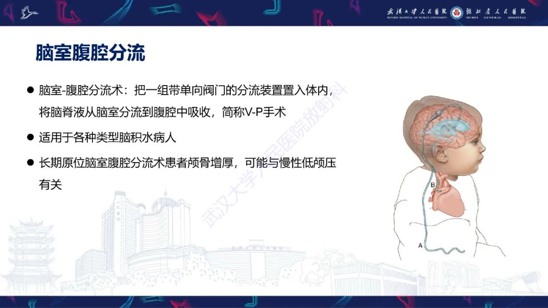 影像PPT - 【PPT】颅骨弥漫性病变影像诊断-35
