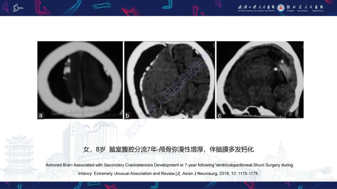 影像PPT - 【PPT】颅骨弥漫性病变影像诊断-37