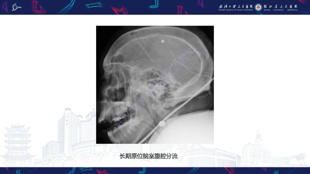 影像PPT - 【PPT】颅骨弥漫性病变影像诊断-36