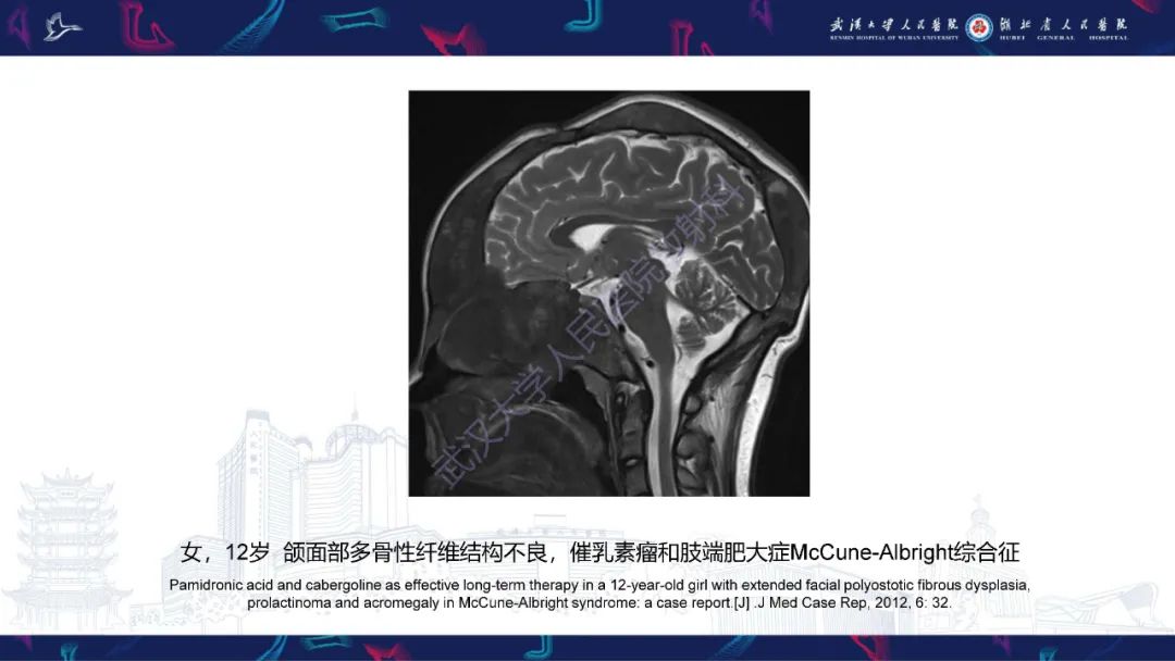 影像PPT - 【PPT】颅骨弥漫性病变影像诊断-34