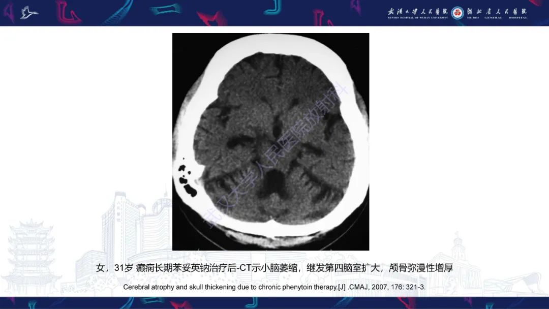影像PPT - 【PPT】颅骨弥漫性病变影像诊断-39