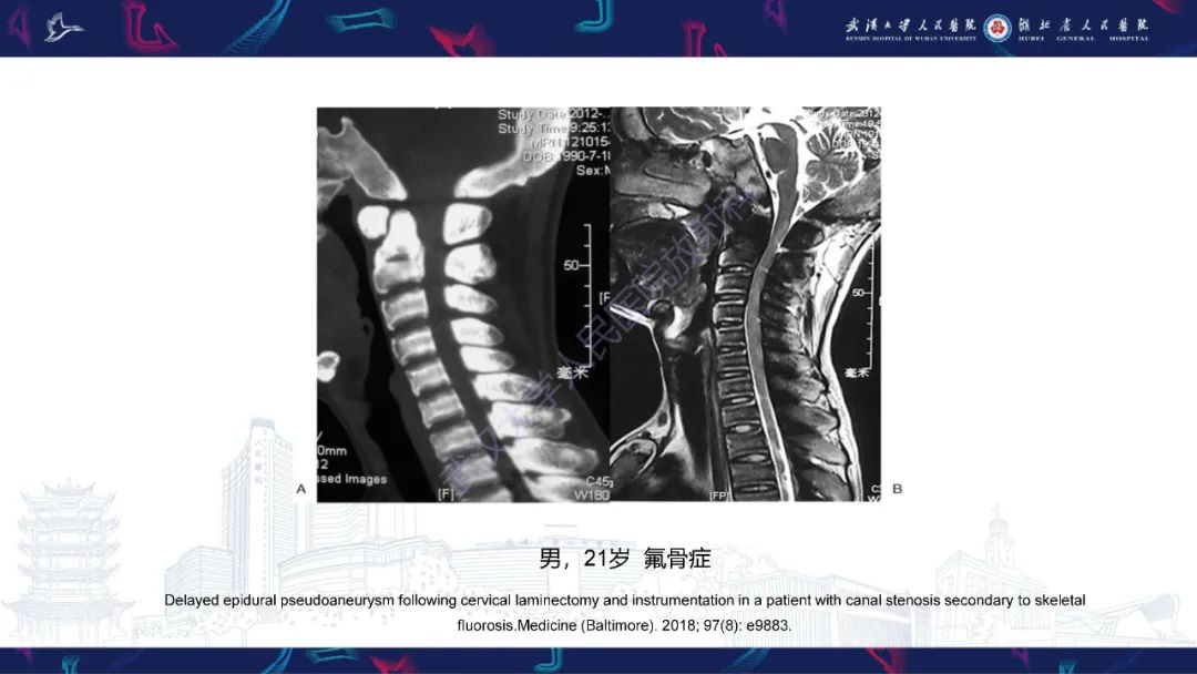 影像PPT - 【PPT】颅骨弥漫性病变影像诊断-41
