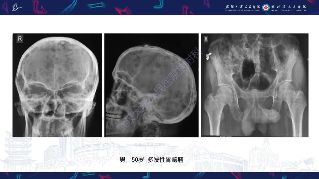 影像PPT - 【PPT】颅骨弥漫性病变影像诊断-43