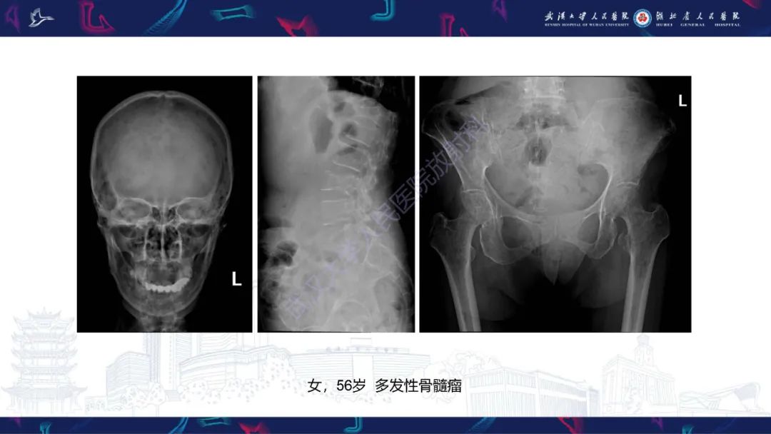 影像PPT - 【PPT】颅骨弥漫性病变影像诊断-44