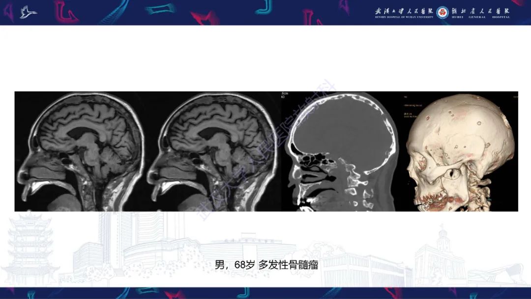影像PPT - 【PPT】颅骨弥漫性病变影像诊断-47