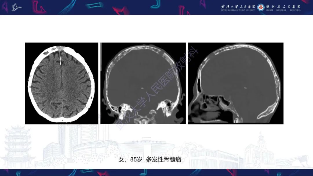影像PPT - 【PPT】颅骨弥漫性病变影像诊断-45