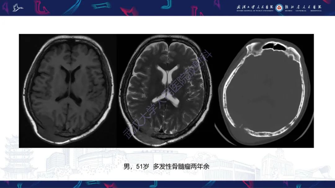影像PPT - 【PPT】颅骨弥漫性病变影像诊断-46