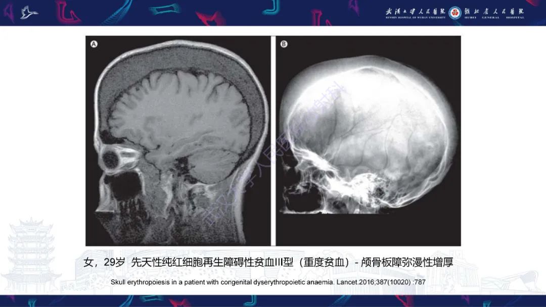 影像PPT - 【PPT】颅骨弥漫性病变影像诊断-49