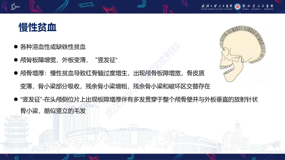 影像PPT - 【PPT】颅骨弥漫性病变影像诊断-48