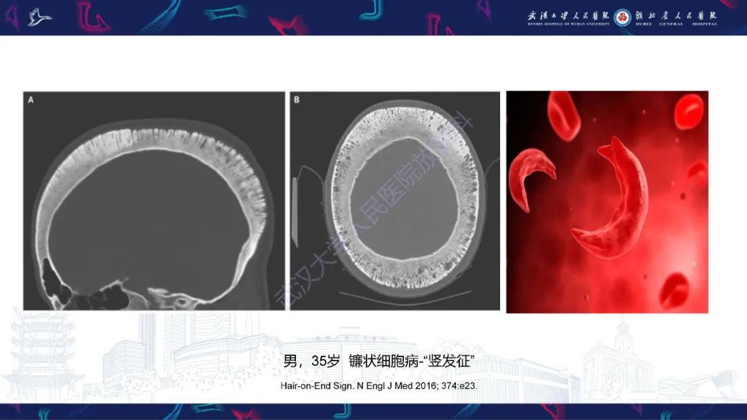 影像PPT - 【PPT】颅骨弥漫性病变影像诊断-50
