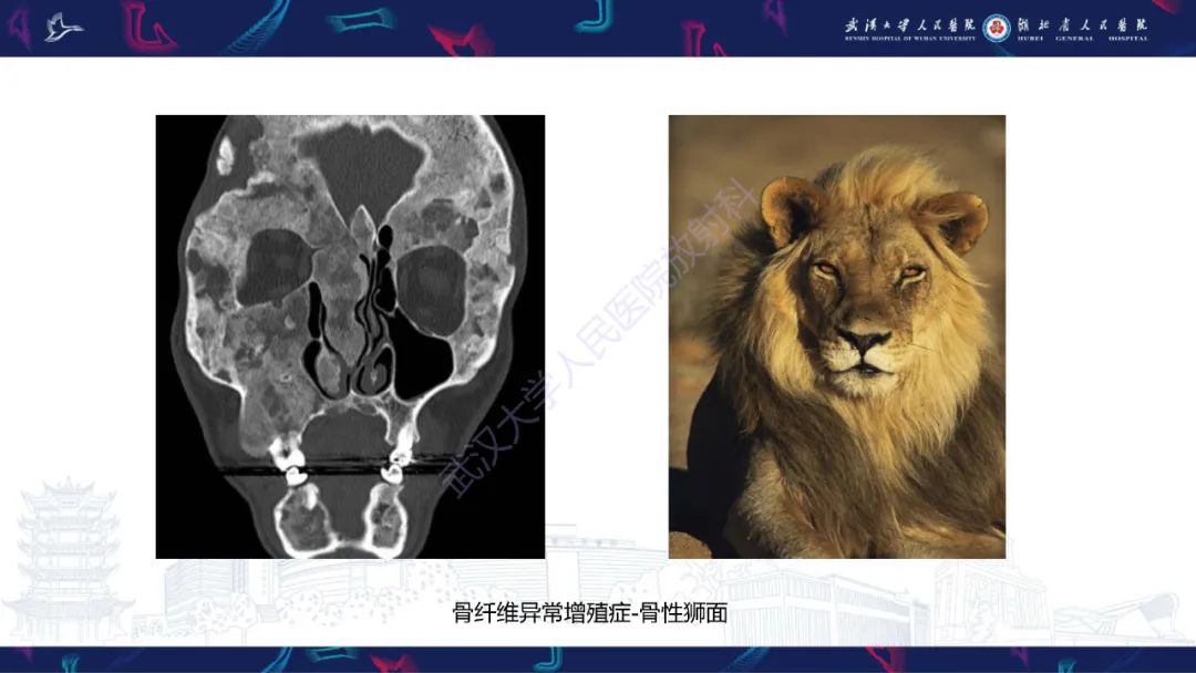 影像PPT - 【PPT】颅骨弥漫性病变影像诊断-55