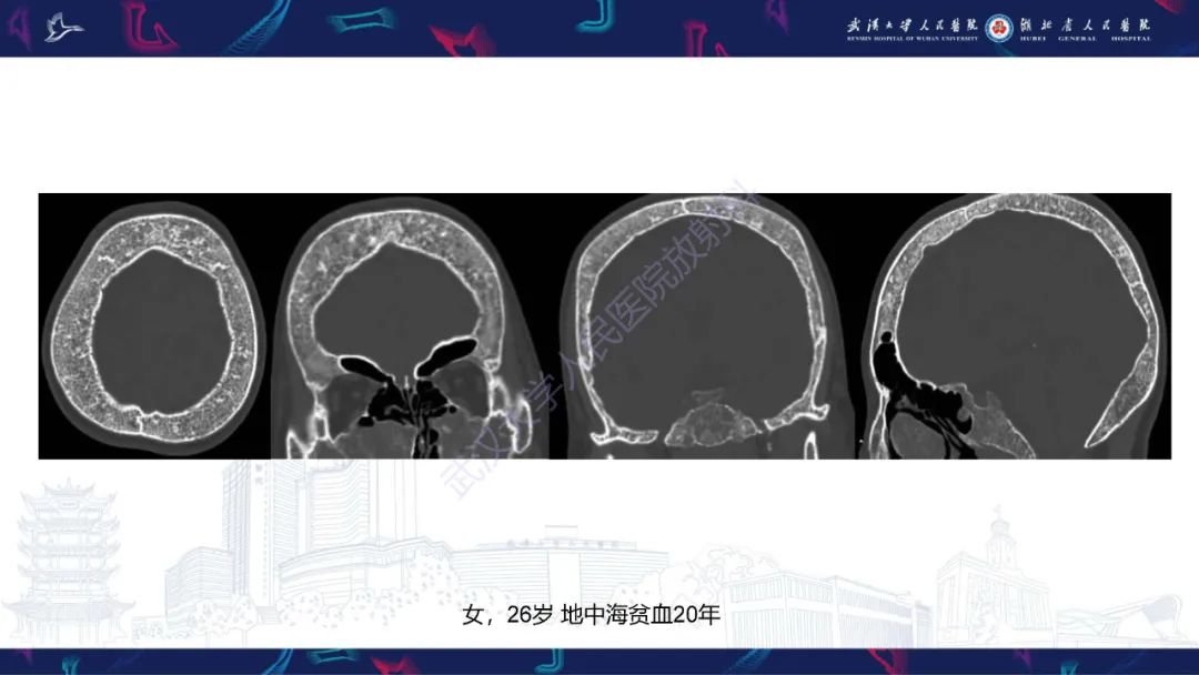 影像PPT - 【PPT】颅骨弥漫性病变影像诊断-52