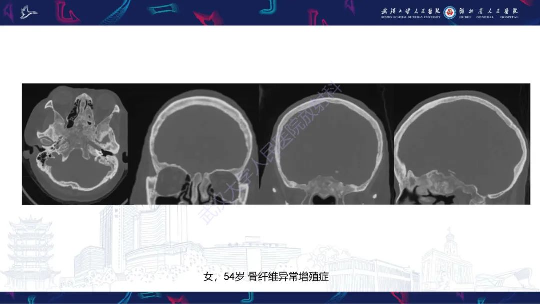 影像PPT - 【PPT】颅骨弥漫性病变影像诊断-54