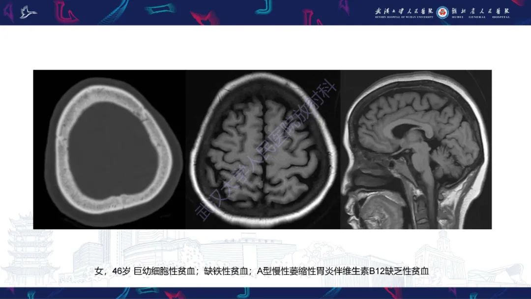 影像PPT - 【PPT】颅骨弥漫性病变影像诊断-51