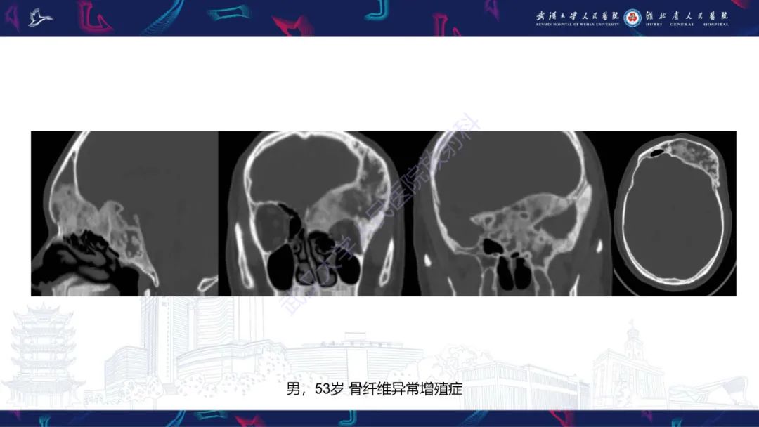 影像PPT - 【PPT】颅骨弥漫性病变影像诊断-56
