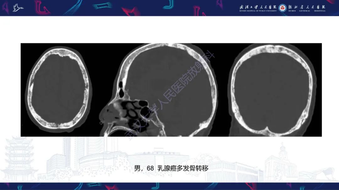 影像PPT - 【PPT】颅骨弥漫性病变影像诊断-59