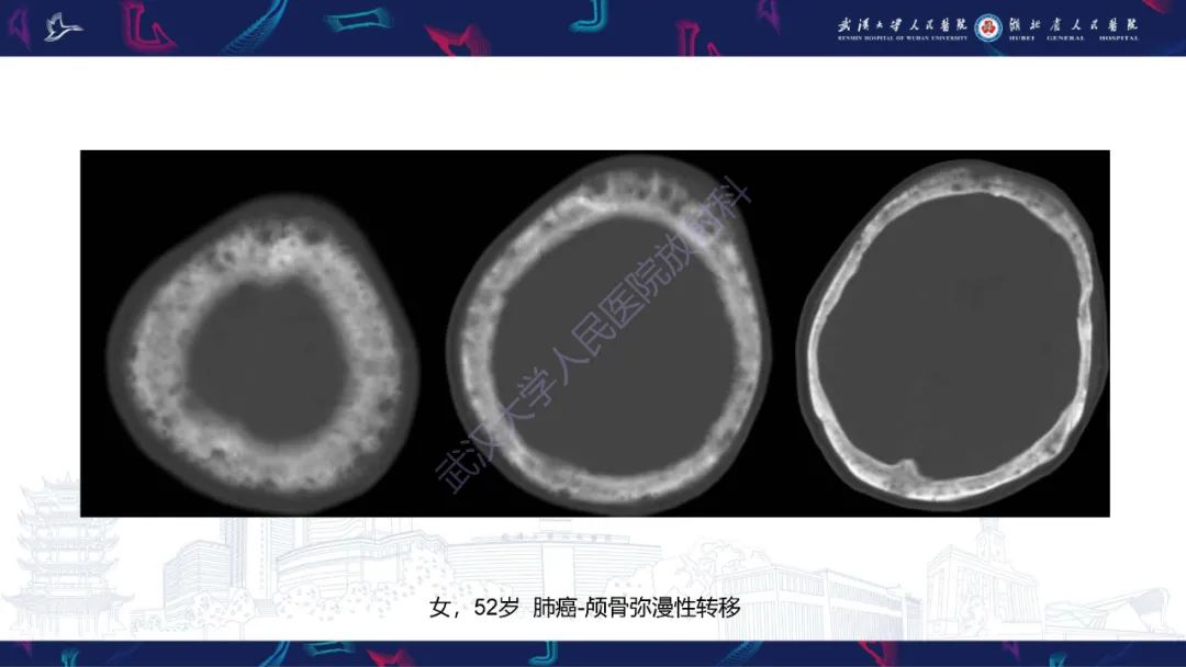 影像PPT - 【PPT】颅骨弥漫性病变影像诊断-58