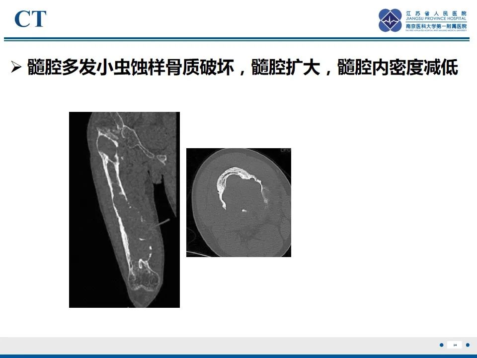 影像PPT - 【PPT】戈谢病-25