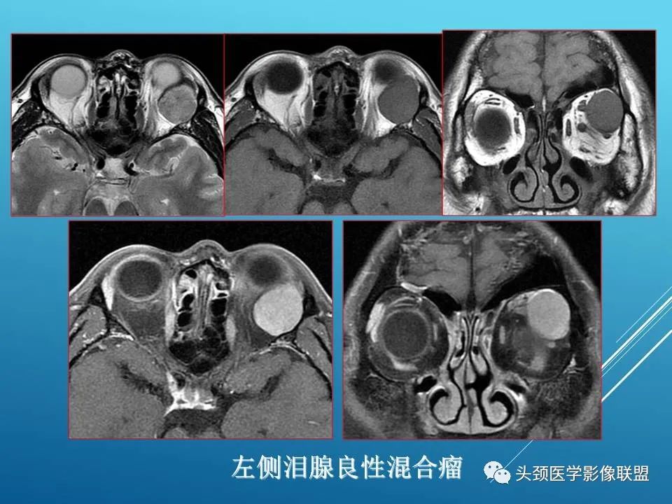 影像PPT - 【PPT】泪腺肿瘤及肿瘤样病变的影像学诊断-8