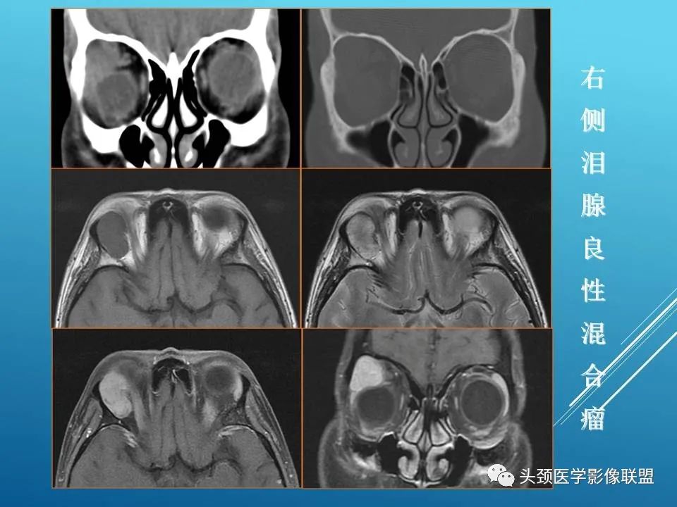 影像PPT - 【PPT】泪腺肿瘤及肿瘤样病变的影像学诊断-7