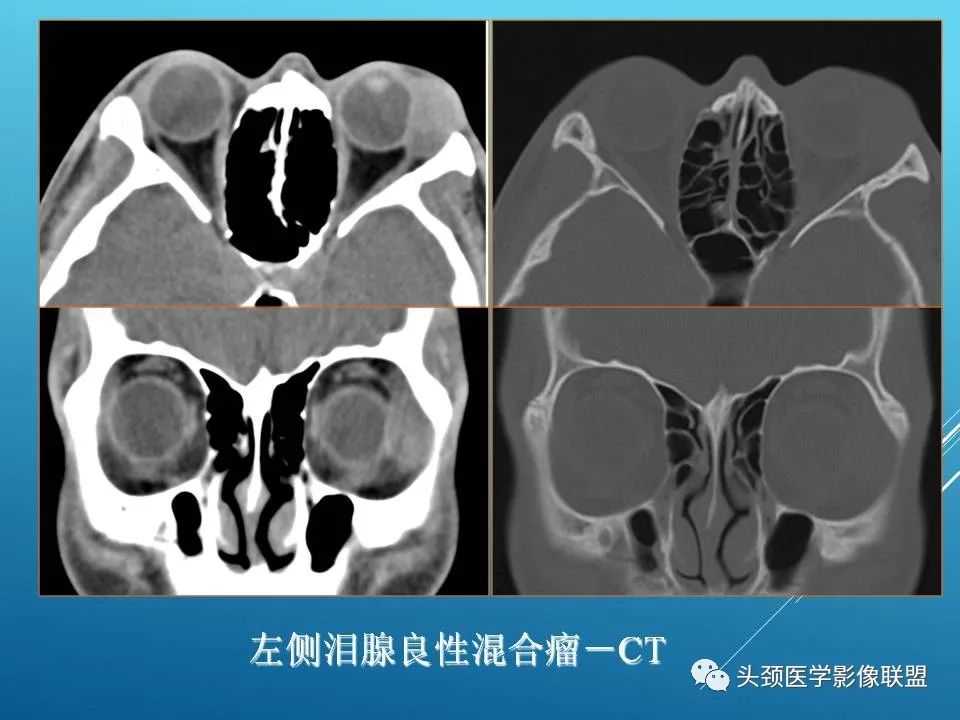 影像PPT - 【PPT】泪腺肿瘤及肿瘤样病变的影像学诊断-10