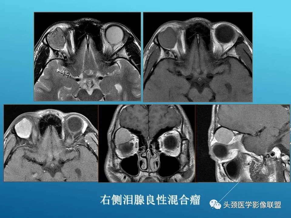 影像PPT - 【PPT】泪腺肿瘤及肿瘤样病变的影像学诊断-9