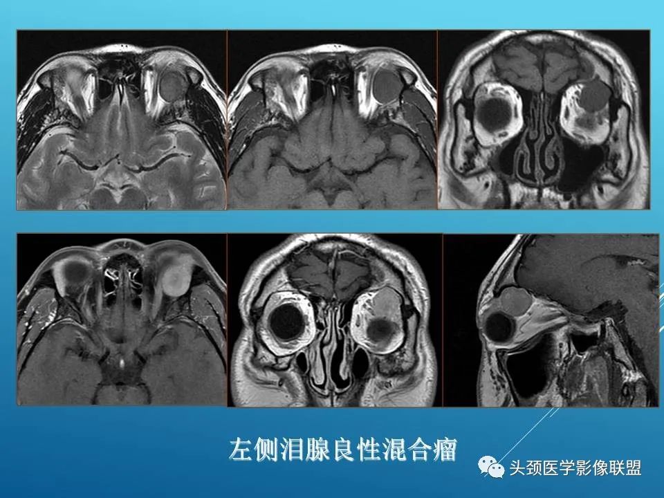 影像PPT - 【PPT】泪腺肿瘤及肿瘤样病变的影像学诊断-12