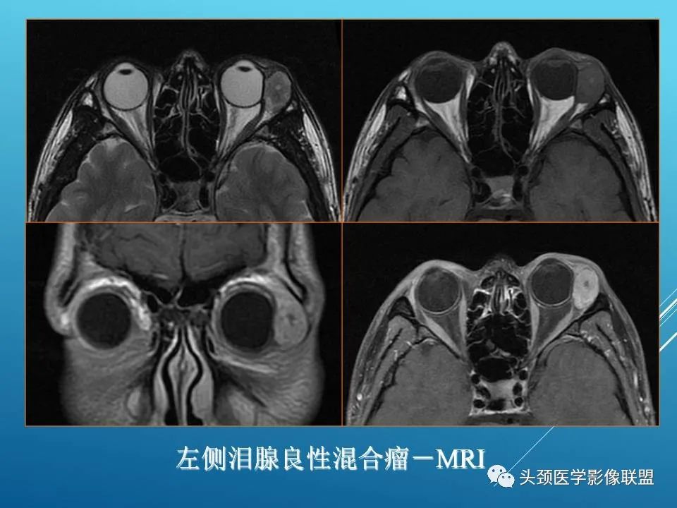 影像PPT - 【PPT】泪腺肿瘤及肿瘤样病变的影像学诊断-11