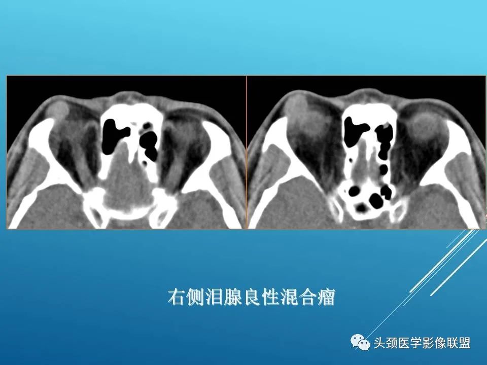 影像PPT - 【PPT】泪腺肿瘤及肿瘤样病变的影像学诊断-13