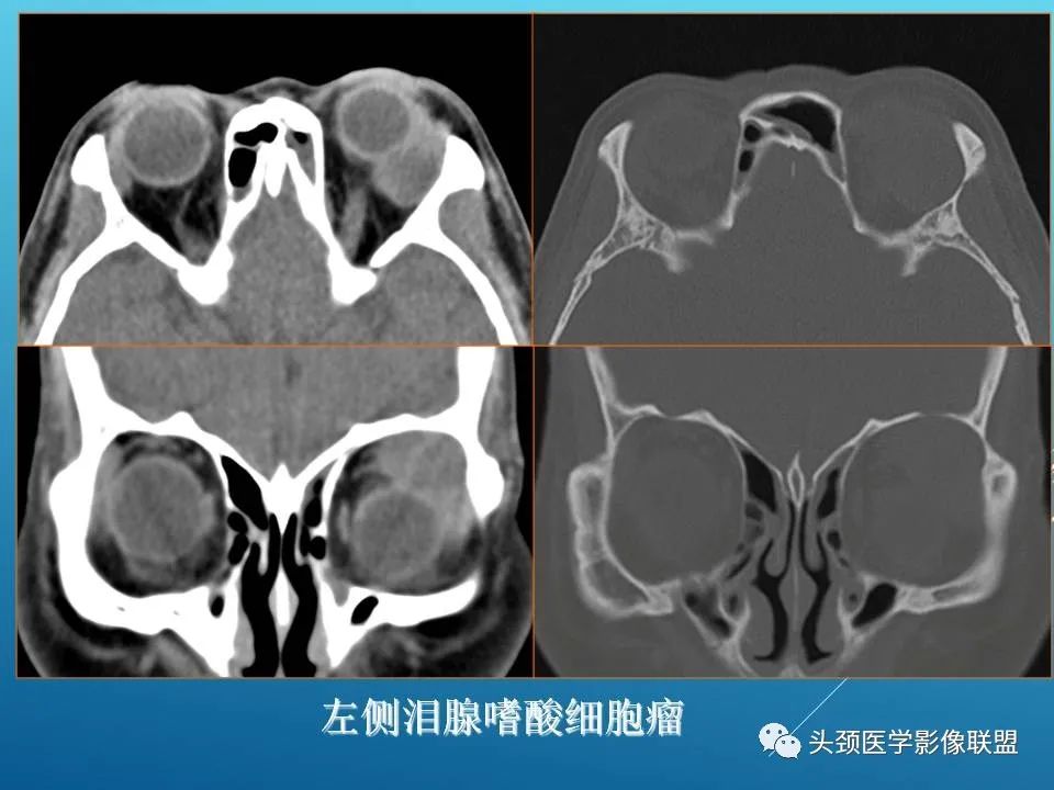 影像PPT - 【PPT】泪腺肿瘤及肿瘤样病变的影像学诊断-15