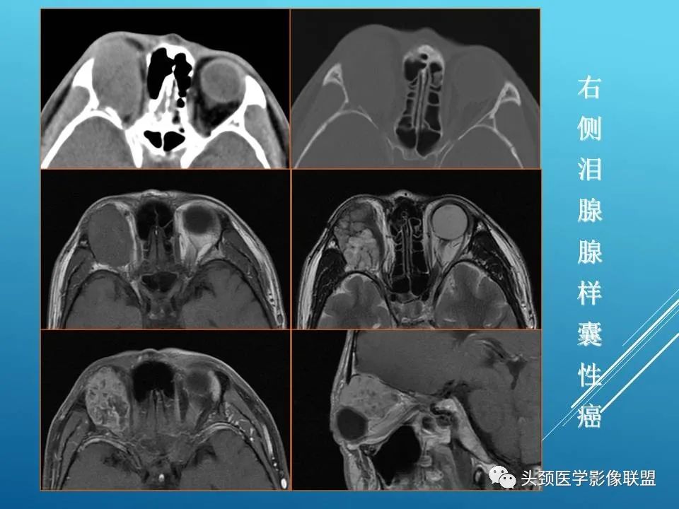 影像PPT - 【PPT】泪腺肿瘤及肿瘤样病变的影像学诊断-24