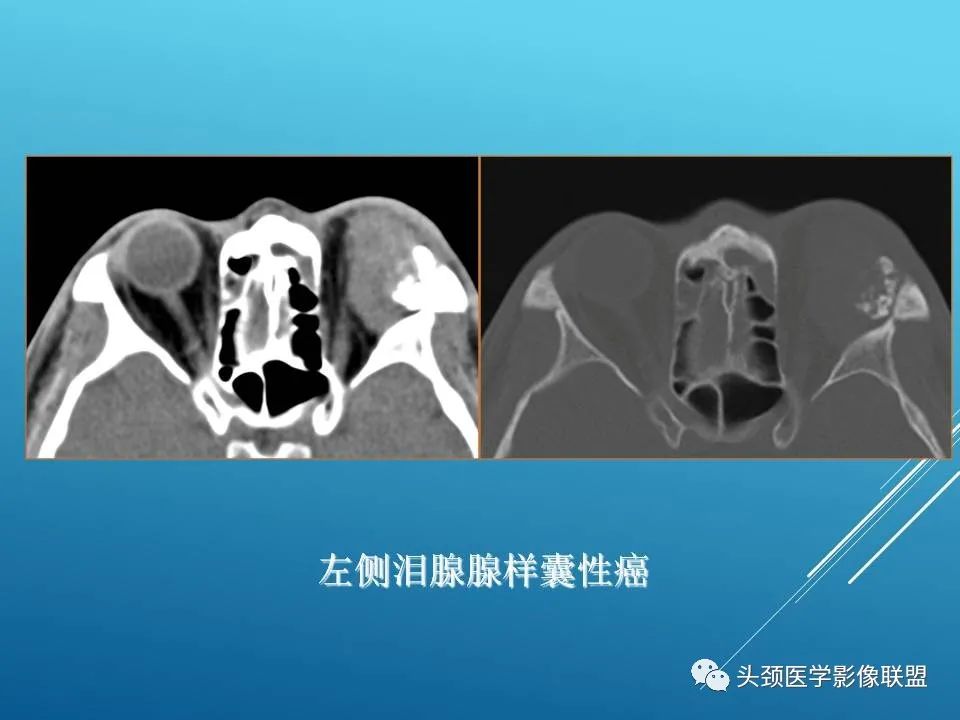 影像PPT - 【PPT】泪腺肿瘤及肿瘤样病变的影像学诊断-25