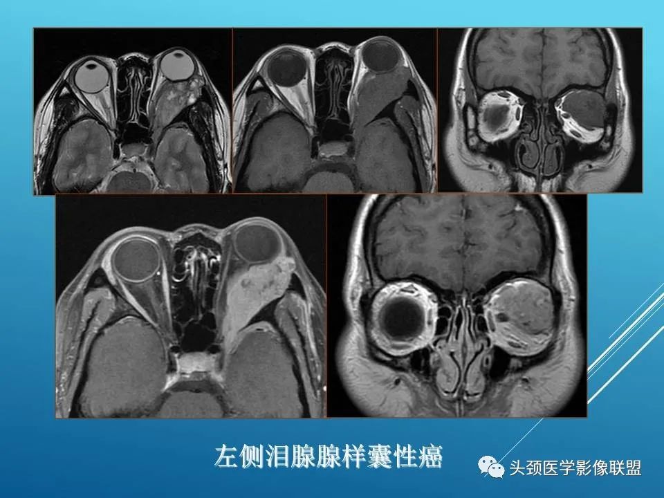 影像PPT - 【PPT】泪腺肿瘤及肿瘤样病变的影像学诊断-26