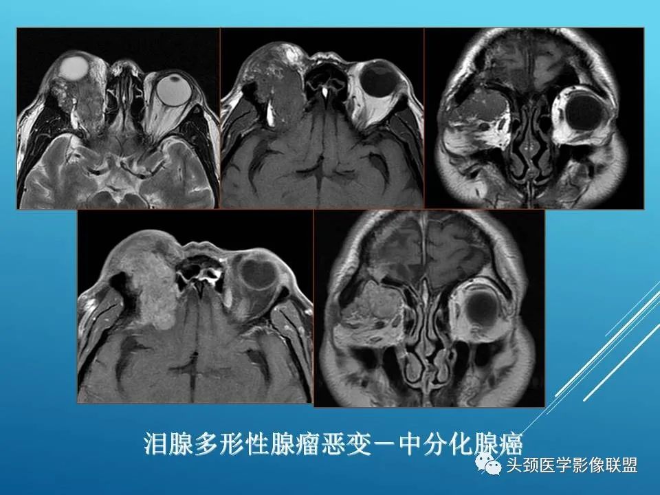 影像PPT - 【PPT】泪腺肿瘤及肿瘤样病变的影像学诊断-27