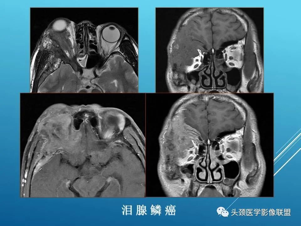 影像PPT - 【PPT】泪腺肿瘤及肿瘤样病变的影像学诊断-28