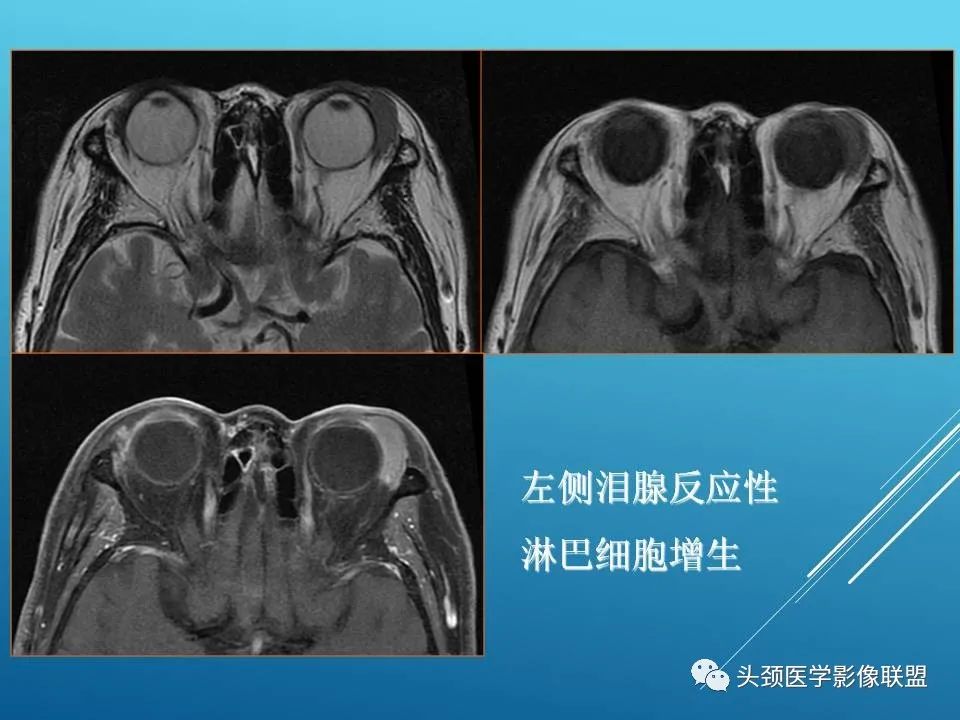 影像PPT - 【PPT】泪腺肿瘤及肿瘤样病变的影像学诊断-35