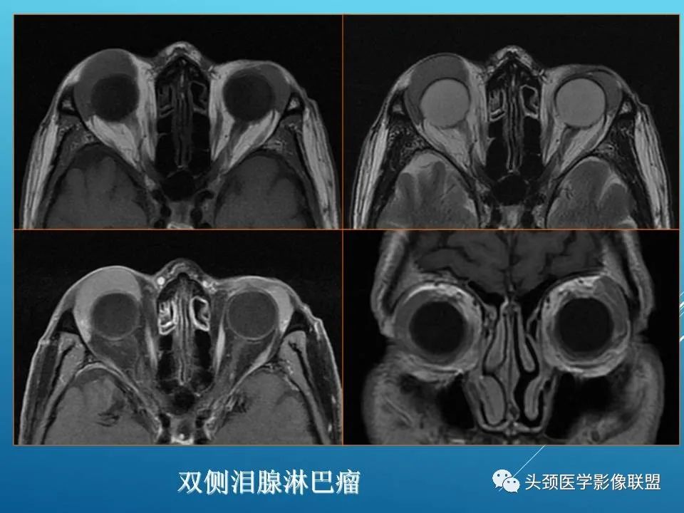 影像PPT - 【PPT】泪腺肿瘤及肿瘤样病变的影像学诊断-36