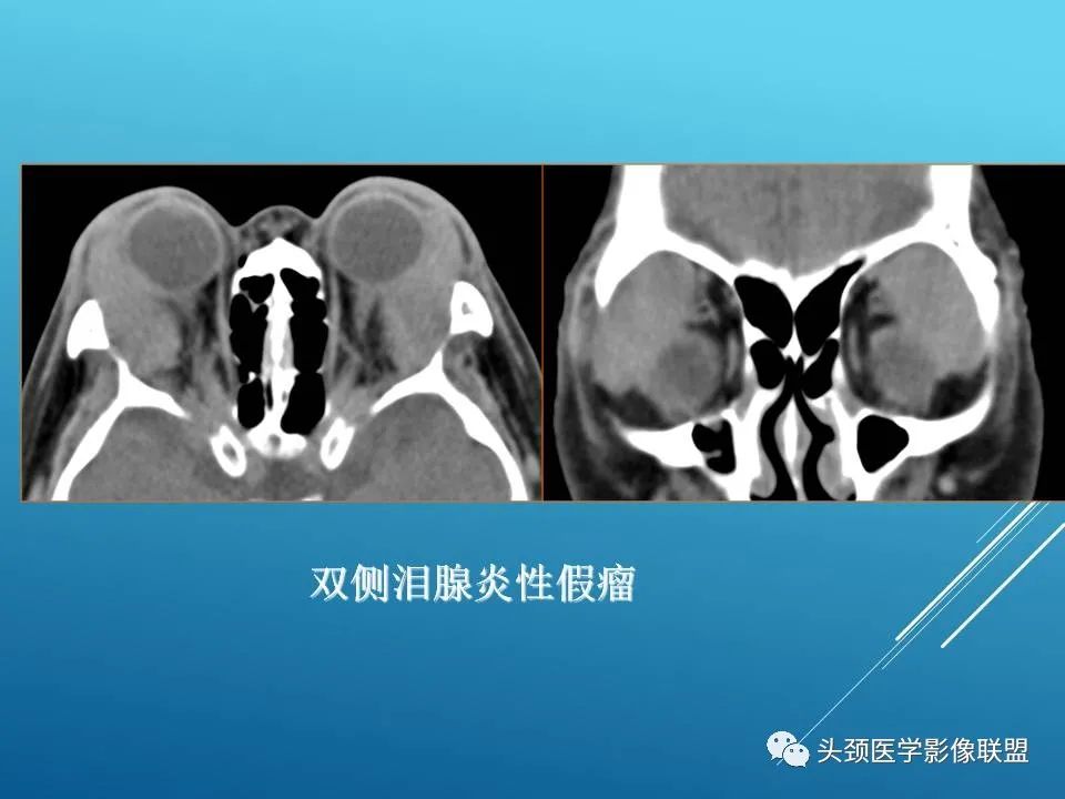 影像PPT - 【PPT】泪腺肿瘤及肿瘤样病变的影像学诊断-40