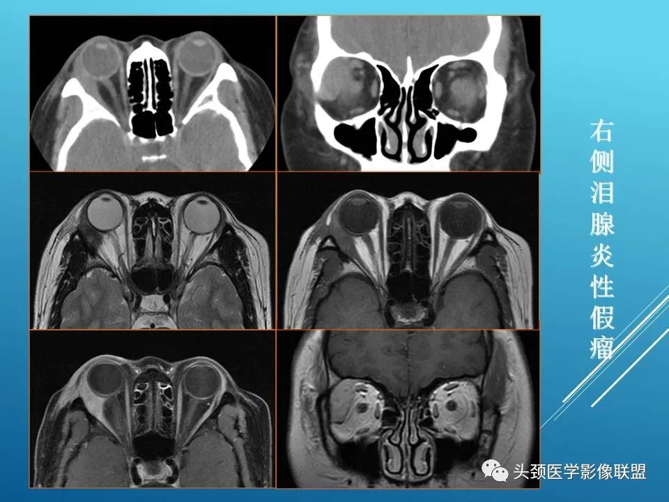 影像PPT - 【PPT】泪腺肿瘤及肿瘤样病变的影像学诊断-41
