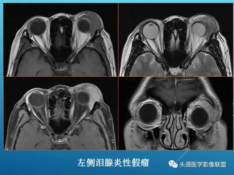 影像PPT - 【PPT】泪腺肿瘤及肿瘤样病变的影像学诊断-42