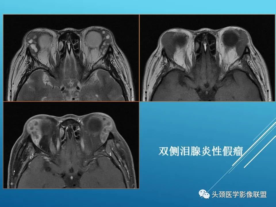 影像PPT - 【PPT】泪腺肿瘤及肿瘤样病变的影像学诊断-43