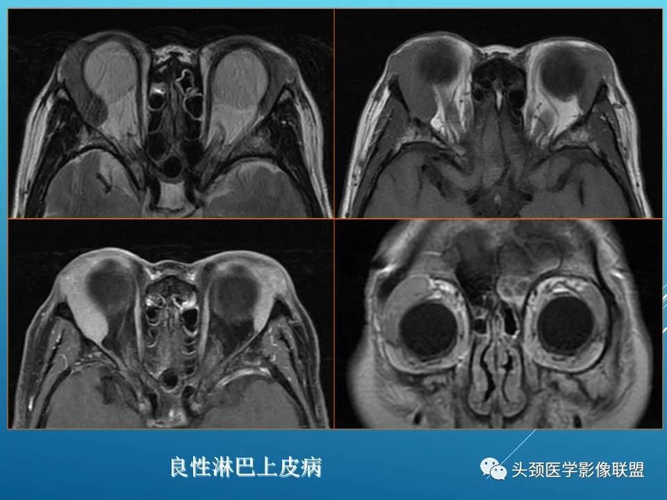 影像PPT - 【PPT】泪腺肿瘤及肿瘤样病变的影像学诊断-48